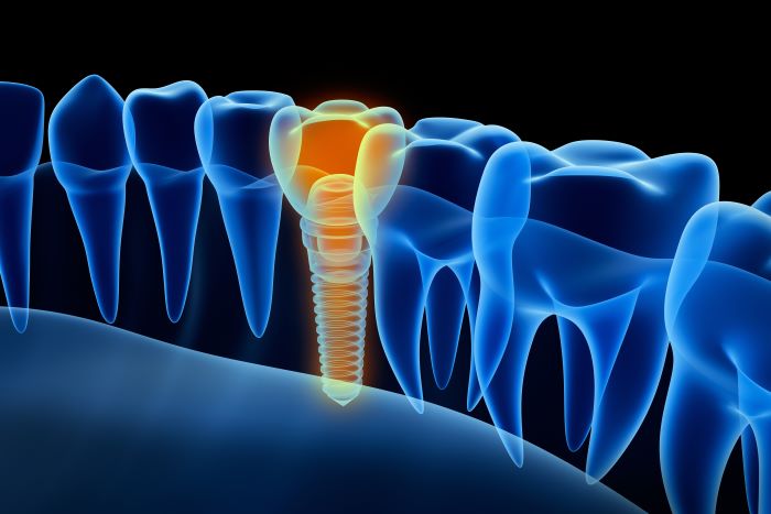 Evolution Dental Implants