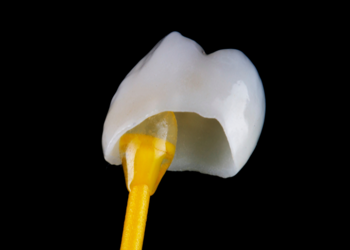 dental crown Orem Utah