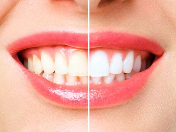 Teeth Whitening Orem